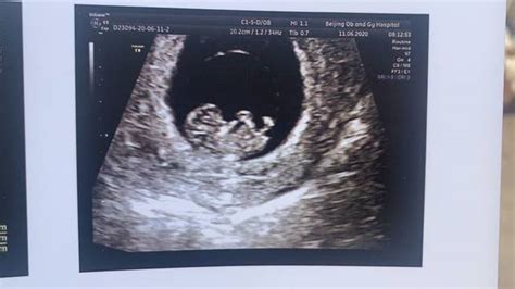 怀孕第9周双胞胎B超图_孕期检查_育儿_99健康网