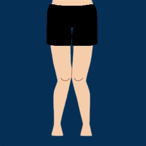 Medical Term For Knock Knee at Declan Thwaites blog