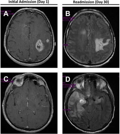 Herpes Simplex Virus (HSV-1) Encephalitis Mimicking Glioblastoma: Case ...