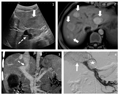 Presentation of Congenital Portosystemic Shunts in Children