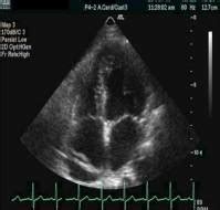 What is Diastolic Dysfunction? | Dr. Sameer Srivastava