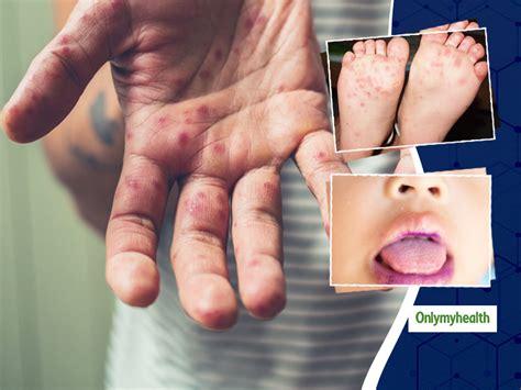 Hand Foot And Mouth Disease (HFMD) is Common in Small Kids Know Its ...