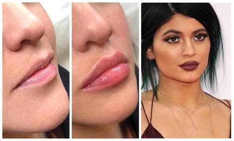 Meet Lip Threads, the New Lip Fillers That Promise You a Better Pout ...