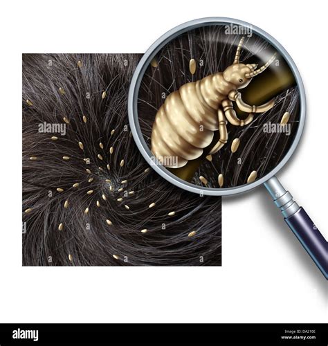 Head lice eggs hi-res stock photography and images - Alamy