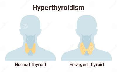 Image result for hyperthyroidism