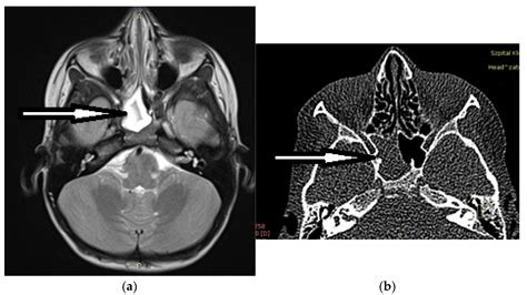 Isolated Sphenoid Sinus Disease in Children
