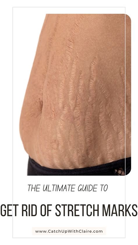 Skin growths | Stretch mark cream pregnancy, Stretch mark removal, Get ...