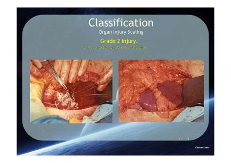 Spleen Trauma Classification | PDF