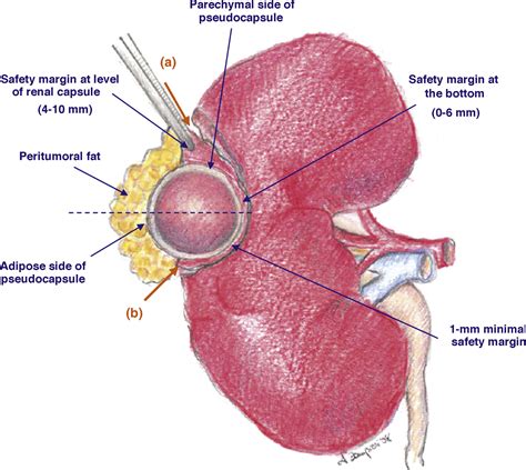 Image result for Simple Nephrectomy