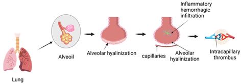 Acute Lung Injury Induced by Hyperbaric Oxygen or Other External ...