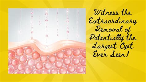 Largest Exploding Cyst 的图像结果