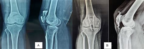 A prospective study to compare the outcome of patellar fractures ...