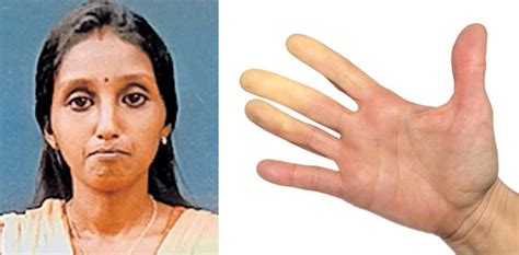 ടിബിയുടെ രൂപത്തിൽ അണുബാധ, സ്ക്ലീറോഡെർമ എന്ന അപൂർവ രോഗം; ശ്വാസമെടുക്കാ ...