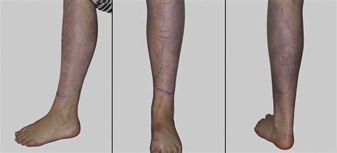 Acrodermatitis Chronica Atrophicans - The Journal of Pediatrics