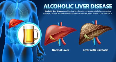 Alcohol Related Liver Disorder: Symptoms, Risks, and Treatment Options