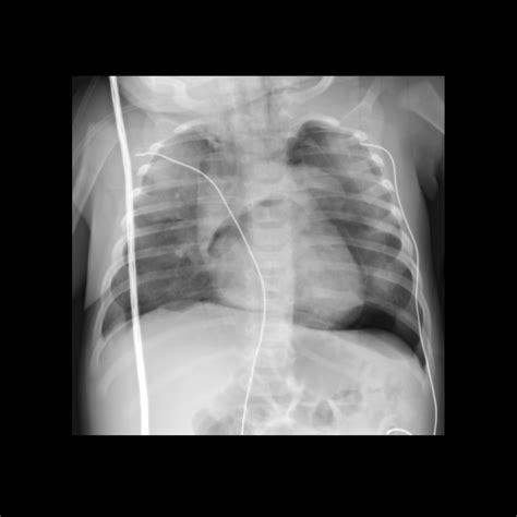 Pediatric Nasogastric Tube Malfunction / Malposition / Misposition ...