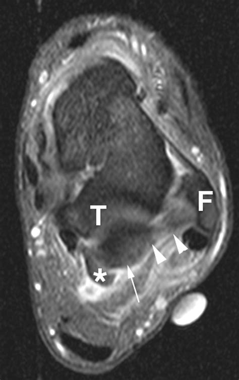 Posterior Ankle Impingement in Professional Soccer Players ...