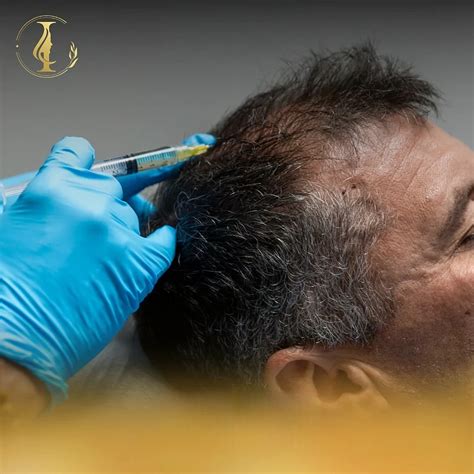 Platelet Rich Plasma Hair Loss Treatment Explained