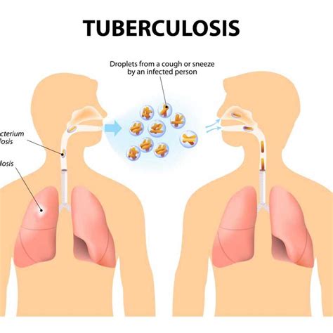 Image result for Tuberculosis Dataset CSV