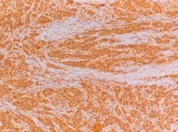 Expression of NEDD9 and connexin-43 in neoplastic and stromal cells of ...