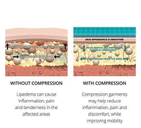 Lipedema Compression Guide: Post-Surgical Benefits & Solutions - The Marena Group, LLC