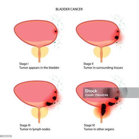 Bladder Cancer Staging