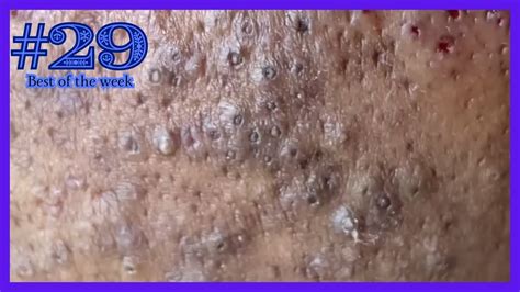 Exploding Pimples 2018 的图像结果