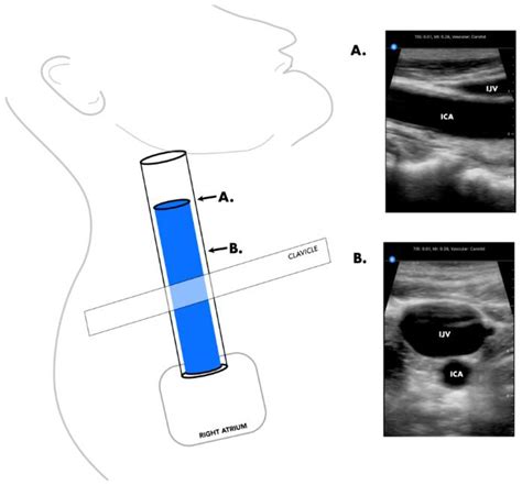 Carotid Versus Jugular Venous Distention