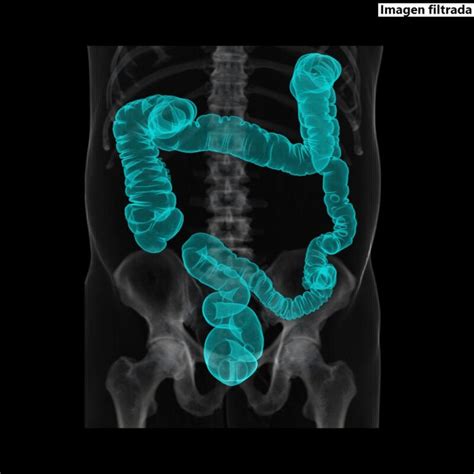 Image result for Endoscopia Virtual Colon