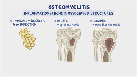 Jaw Bone Infection Symptoms And Osteomyelitis Causes