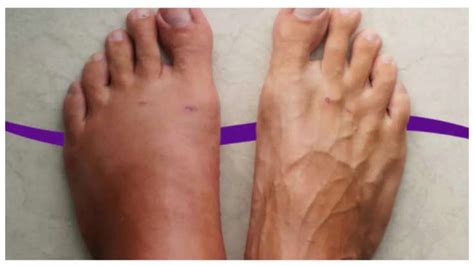 8 health warning signs that the feet can reveal