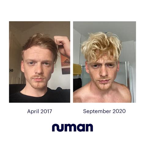 Thomas' hair regrowth story