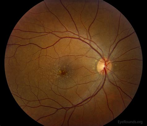 Early onset macular drusen and C3 glomerulopathy (formerly type II membranoproliferative ...