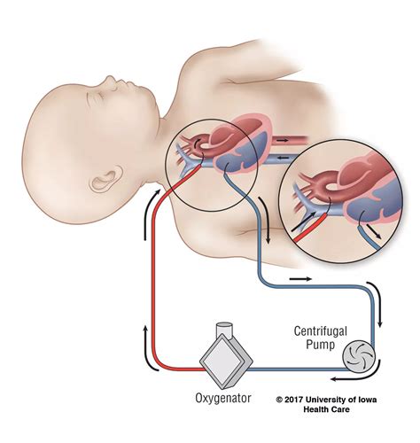 Image result for ECMO Procedure