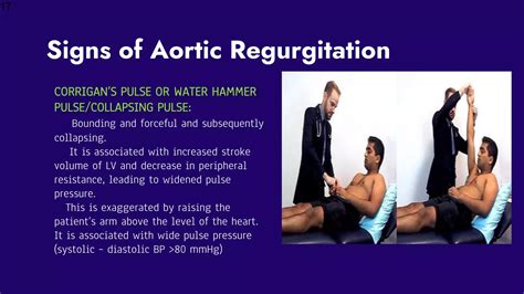 Aortic Regurgitation.pptx