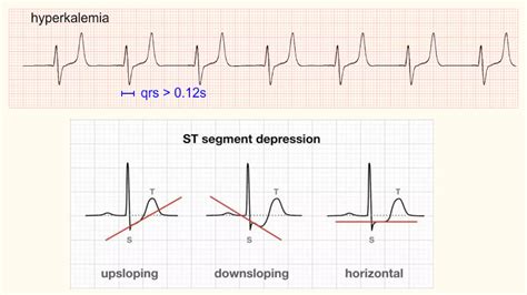 Abnormalities of t wave | PPTX