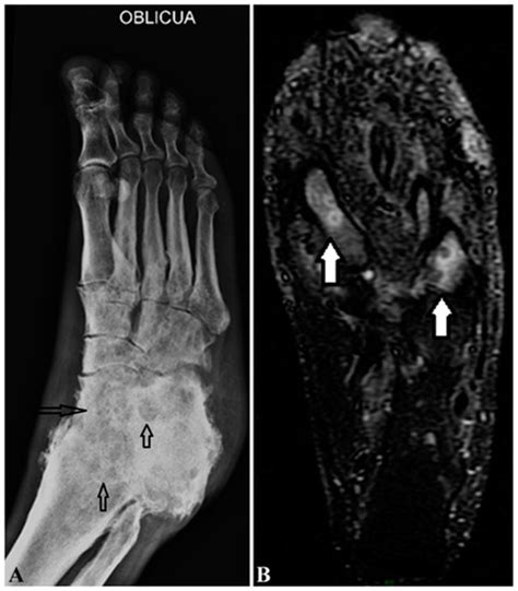 Mycetoma: Development of Diagnosis and Treatment