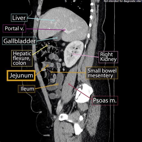Image result for Intestinal Jejunum