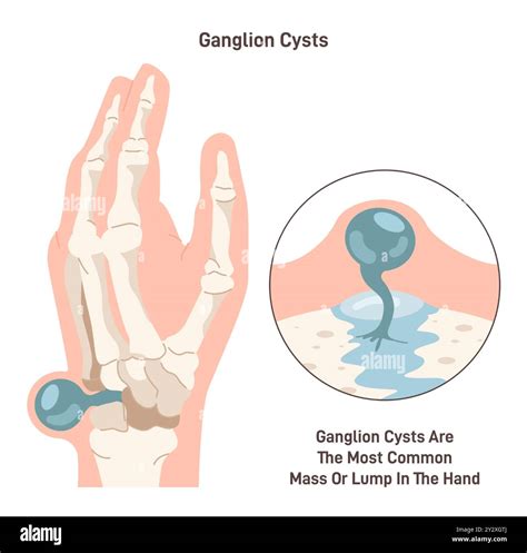 Ganglion cyst. Fluid-filled lump under the skin of a wrist or hand. Synovial cyst over a joint ...