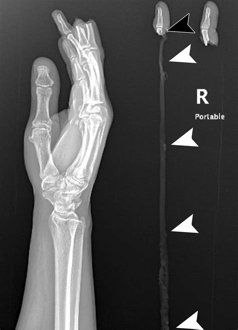 Avulsion Injuries of the Hand and WristRadioGraphics