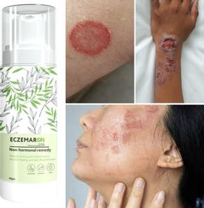 Eczemaron Ringworm Ayurvedic ItchCoat Anti fungal Malam for Ringworm ...