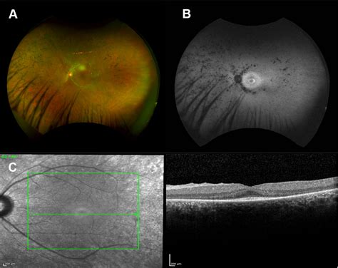 Usher Syndrome Complications Hearts On Hand