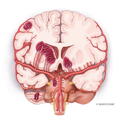 Minimally invasive surgery and transsulcal parafascicular approach in the evacuation of ...