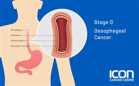 Oesophageal Cancer Explained | Icon Cancer Centre Indonesia