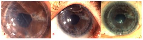 Corneal Artificial Endothelial Layer (EndoArt): Literature Review and ...