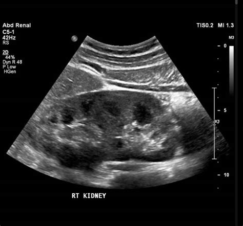 Ecografía Renal y de vías urinarias - INOVA Radiología Intervencionista