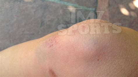 John Elway III Victim -- The Injury Photos