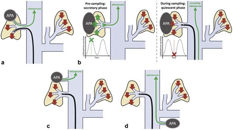 “Double-Down” Adrenal Vein Sampling Results in Patients with Apparent Bilateral Aldosterone ...