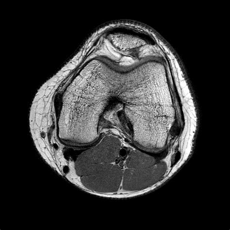 Zimmer Knee Mri at Joseph Florence blog