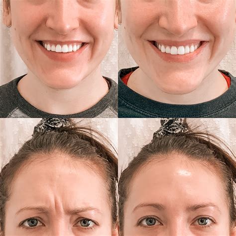Botox Before and After in 2020 | Botox before and after, Lip fillers, Skin care pictures